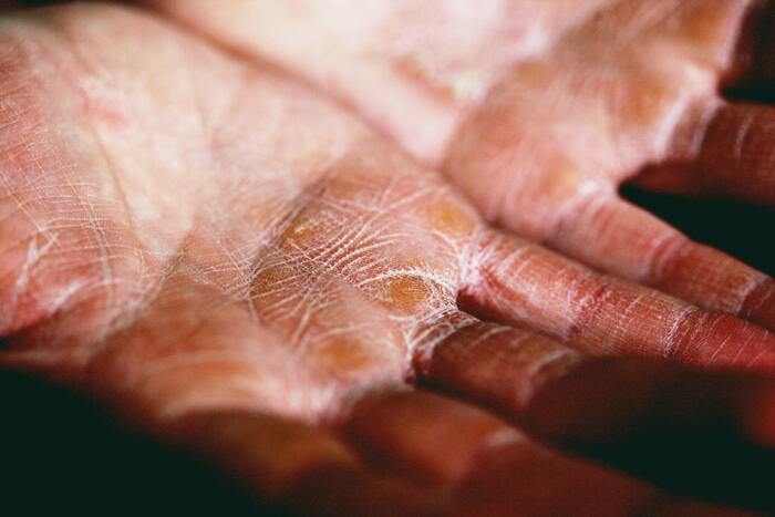 dry hands caused by sauna