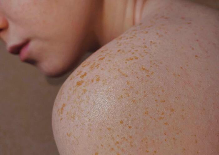 woman with a skin condition